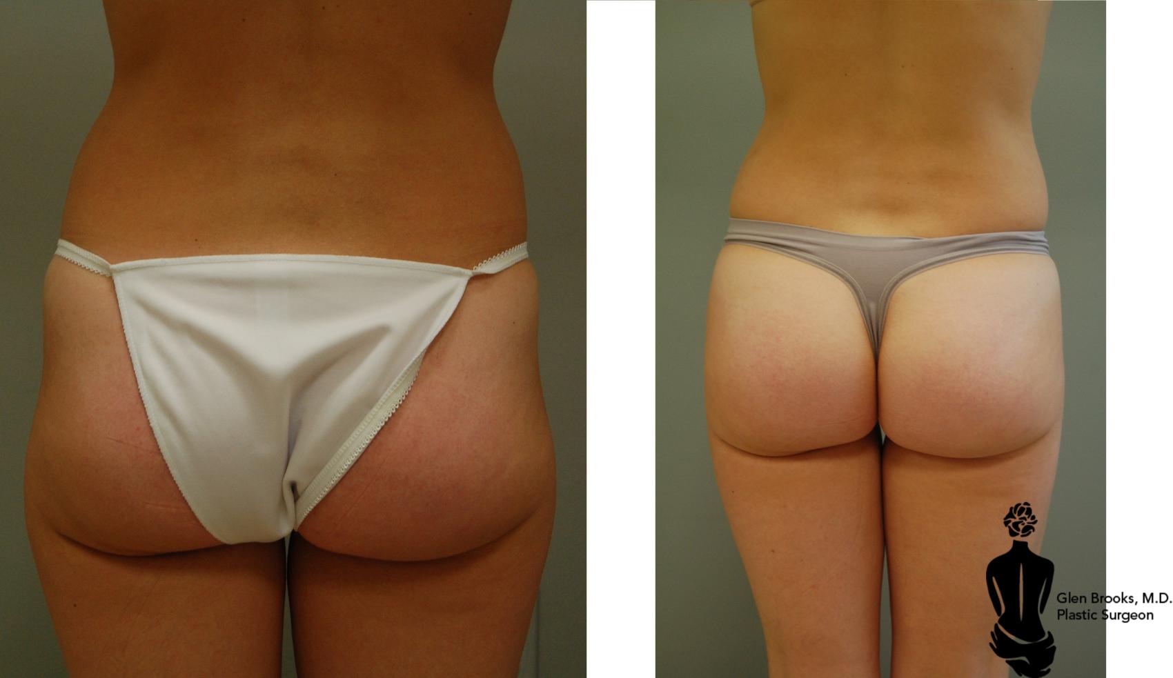 Before & After Liposuction Case 21 View #3 View in Springfield, MA