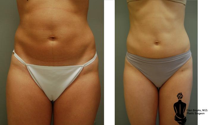Before & After Liposuction Case 21 View #5 View in Springfield, MA