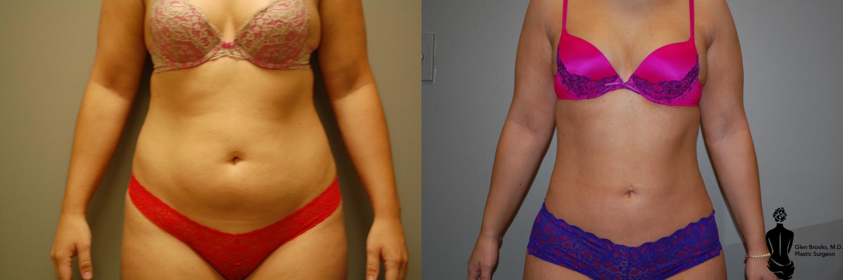 Before & After Liposuction Case 58 View #1 View in Springfield, MA