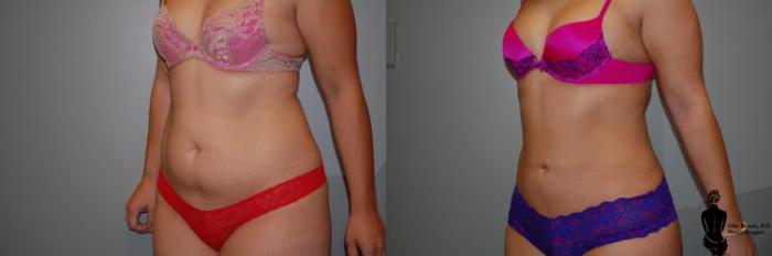 Before & After Liposuction Case 58 View #2 View in Springfield, MA