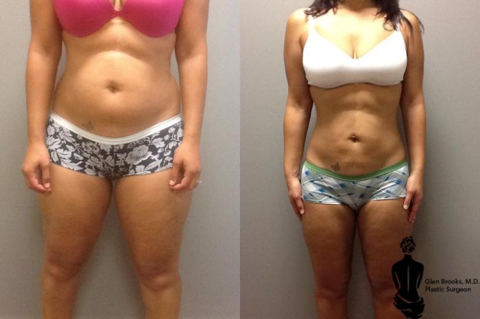 Liposuction Before & After Photos Patient 39, Marietta, GA