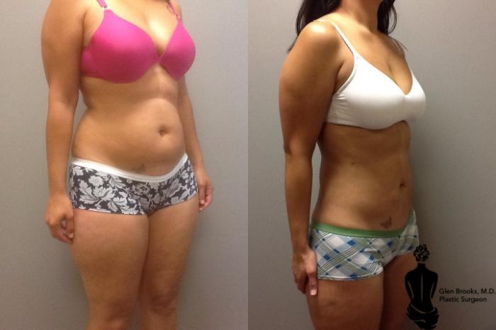 Before & After Liposuction Case 60 View #2 View in Springfield, MA