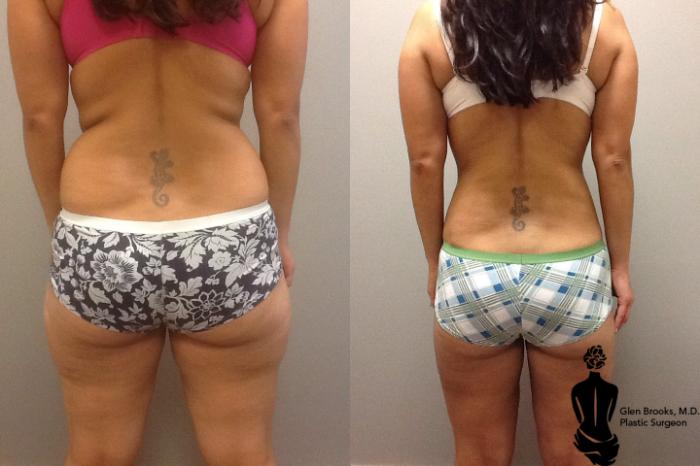 Before & After Liposuction Case 60 View #3 View in Springfield, MA