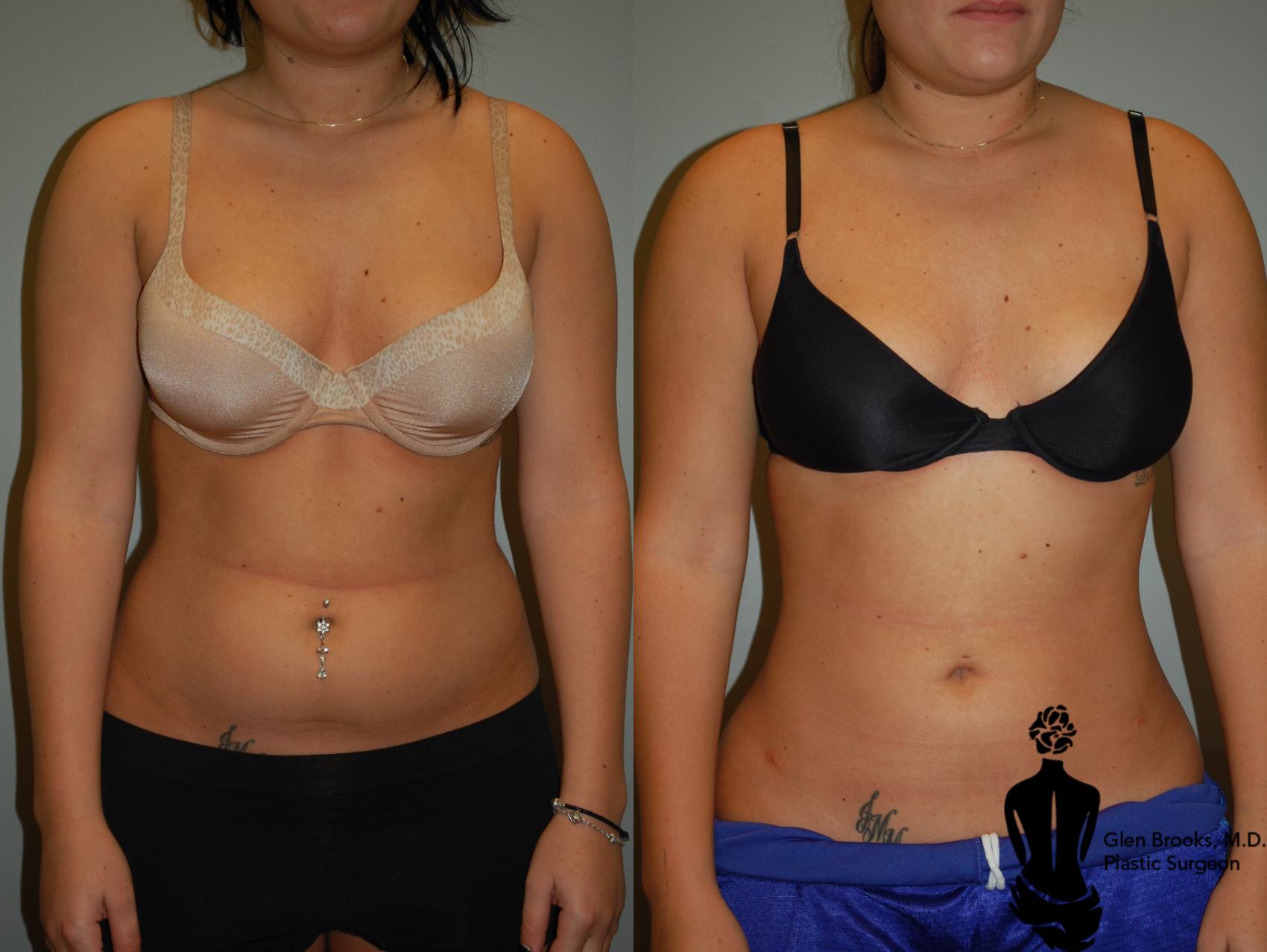 Breast Augmentation Before & After, Case 54