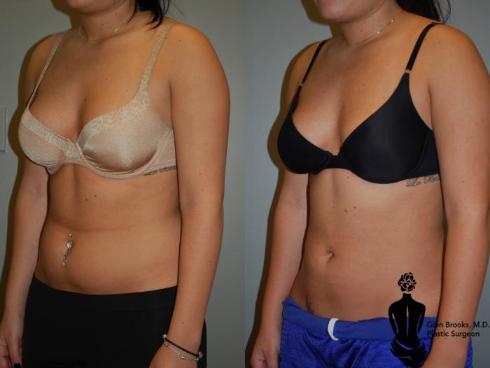 Before & After Liposuction Case 84 View #2 View in Springfield, MA