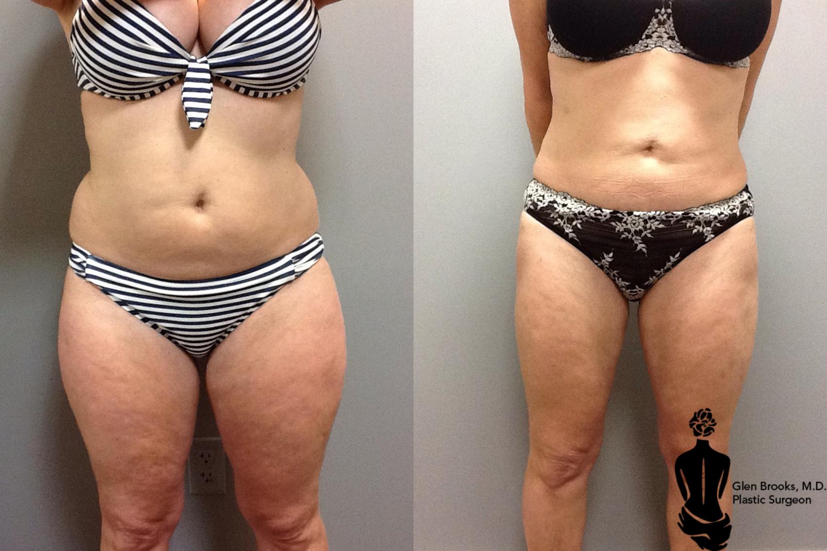 Before & After Liposuction Case 90 View #1 View in Springfield, MA
