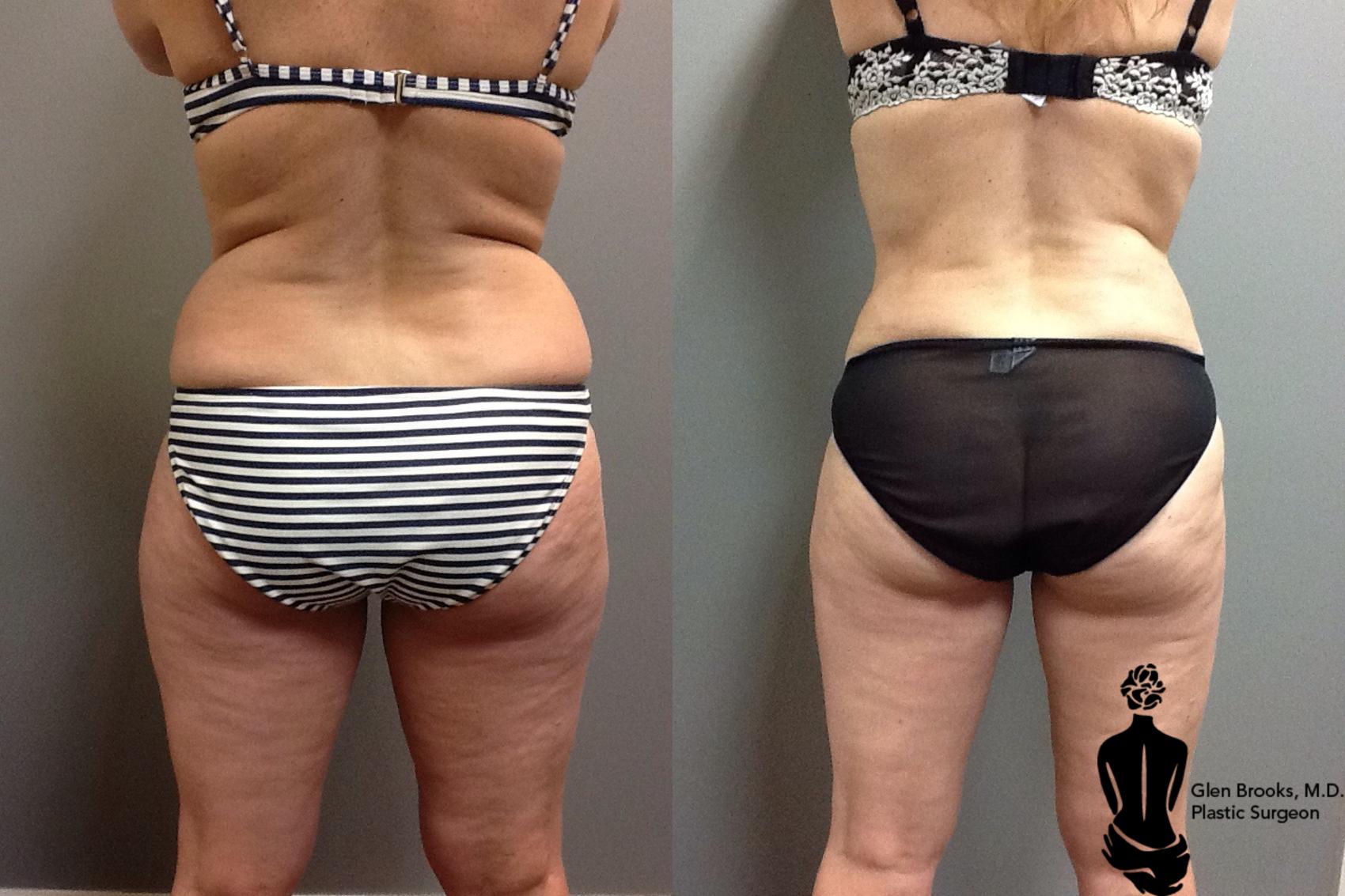 Liposuction Before & After Photo | Springfield, MA | Aesthetic Plastic & Reconstructive Surgery