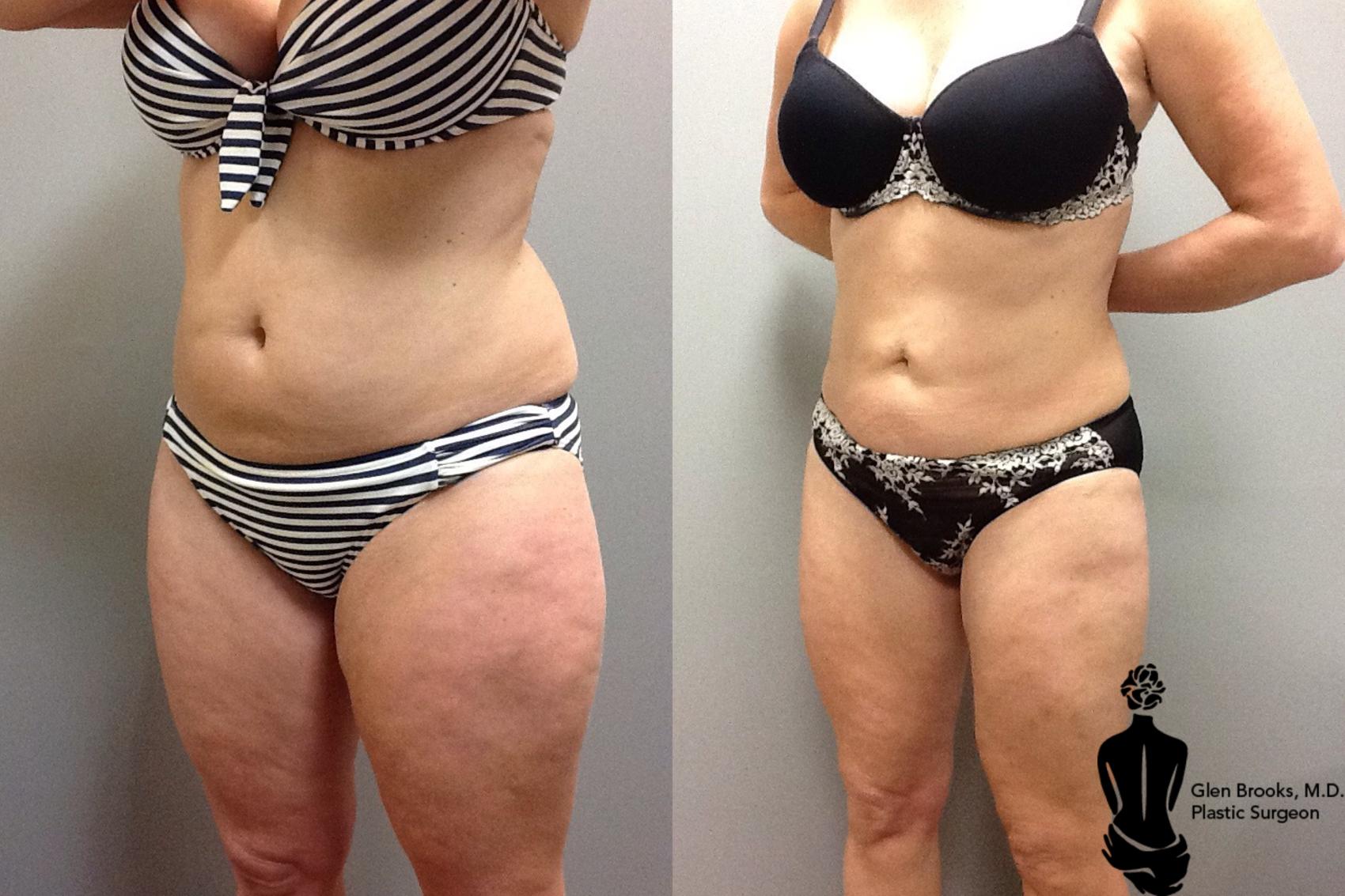 Before & After Liposuction Case 90 View #3 View in Springfield, MA