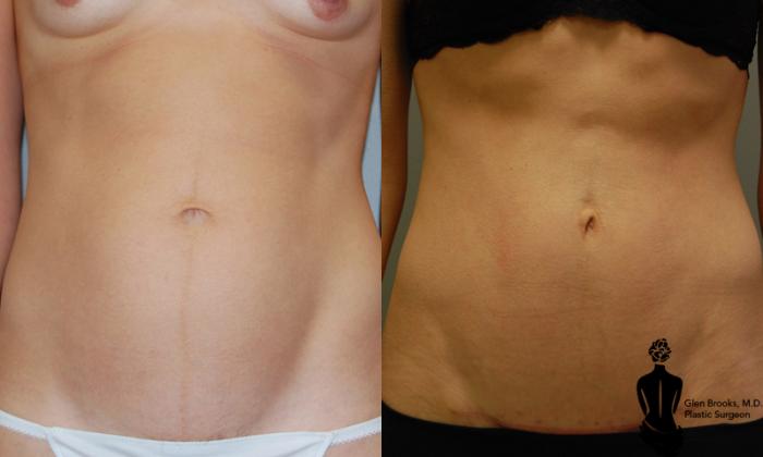 Before & After Mini Tummy Tuck Case 16 View #1 View in Springfield, MA