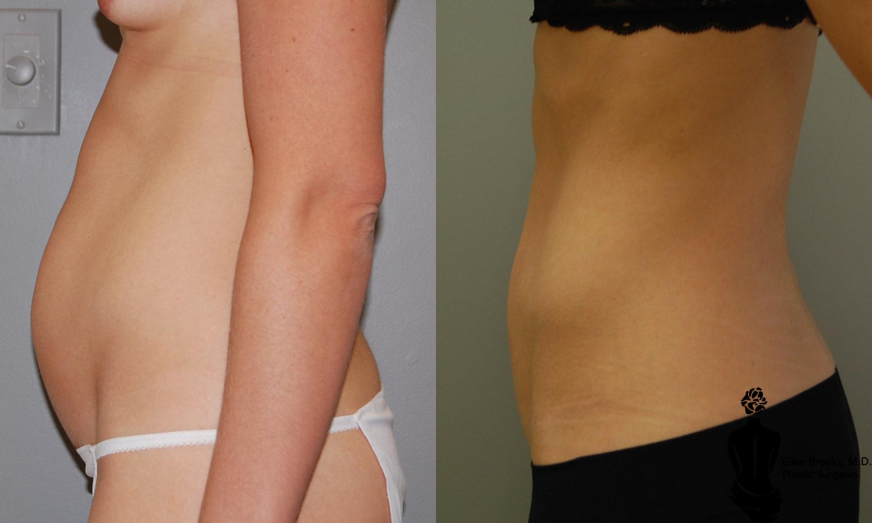 Mini Tummy Tuck Before & After Photo | Springfield, MA | Aesthetic Plastic & Reconstructive Surgery