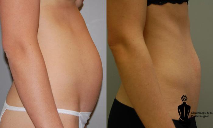 Before & After Mini Tummy Tuck Case 16 View #3 View in Springfield, MA