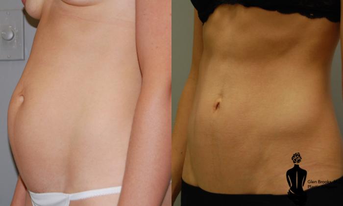Mini Tummy Tuck Before & After Photos Patient 16
