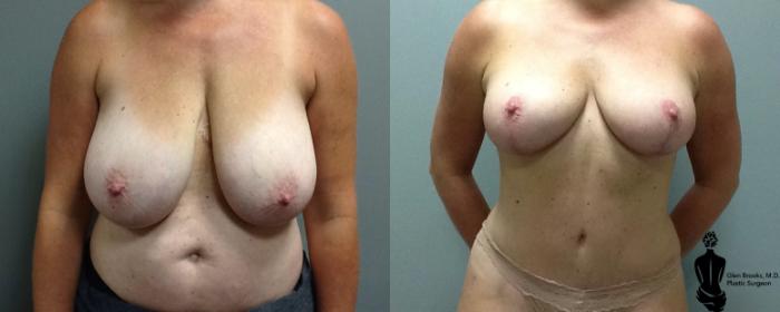 Before & After Multiple Procedures Case 119 View #1 View in Springfield, MA