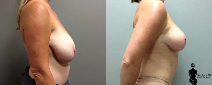 Before & After Multiple Procedures Case 119 View #2 View in Springfield, MA