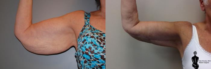Before & After Multiple Procedures Case 74 View #3 View in Springfield, MA