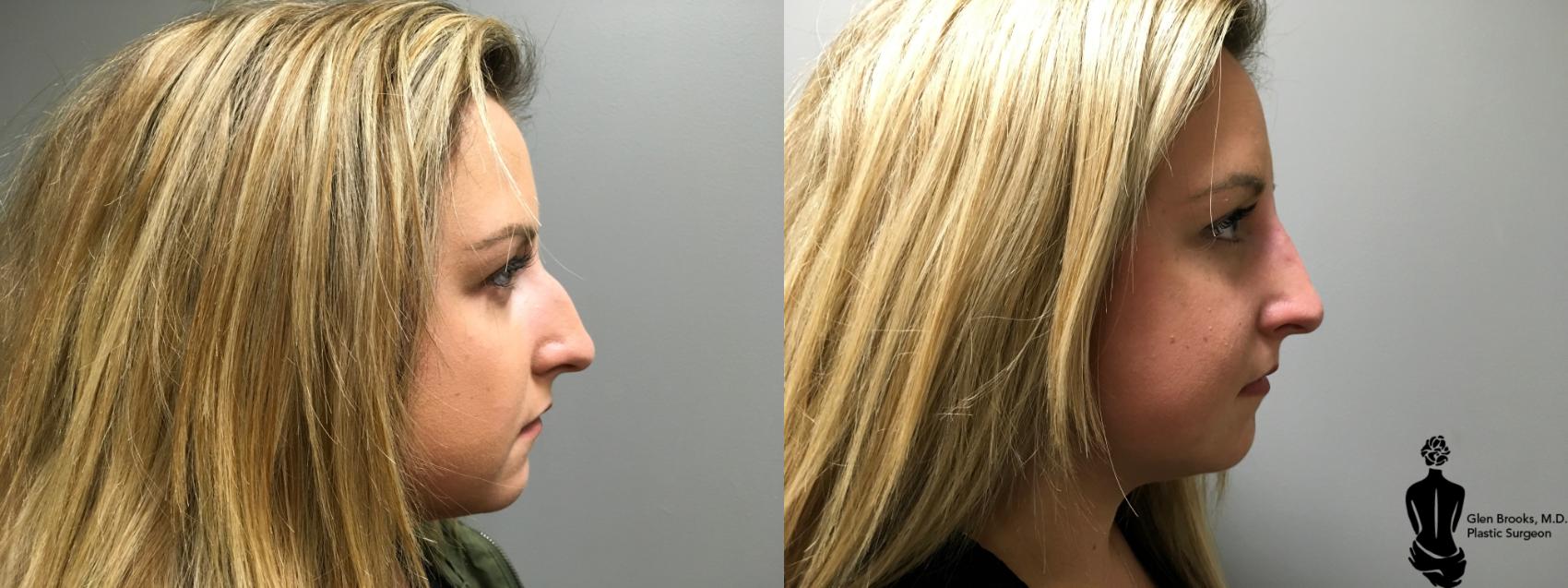 Before & After Rhinoplasty Case 151 View #1 View in Springfield, MA