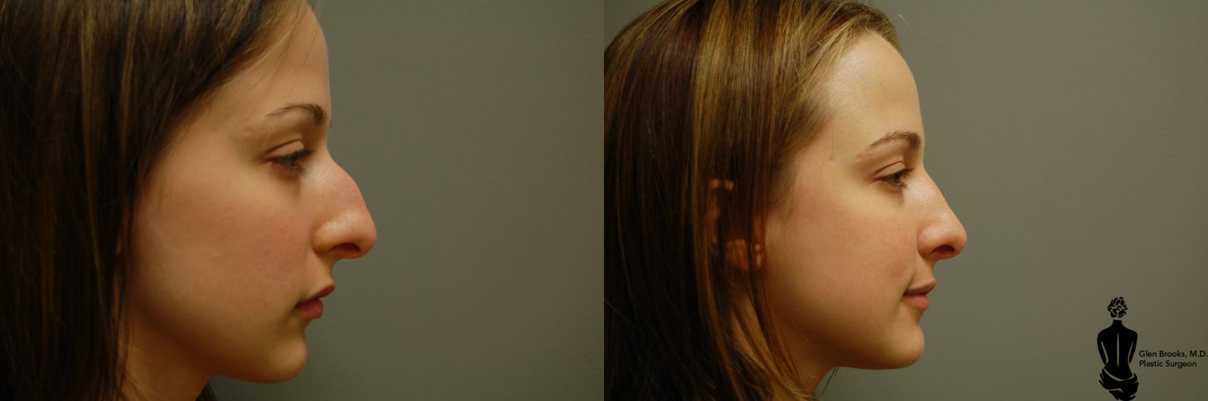 Before & After Rhinoplasty Case 24 View #1 View in Springfield, MA