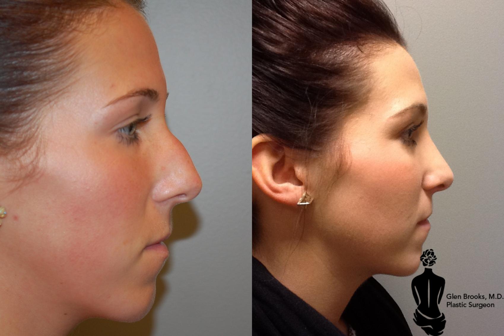 Rhinoplasty Before & After Photo | Springfield, MA | Aesthetic Plastic & Reconstructive Surgery