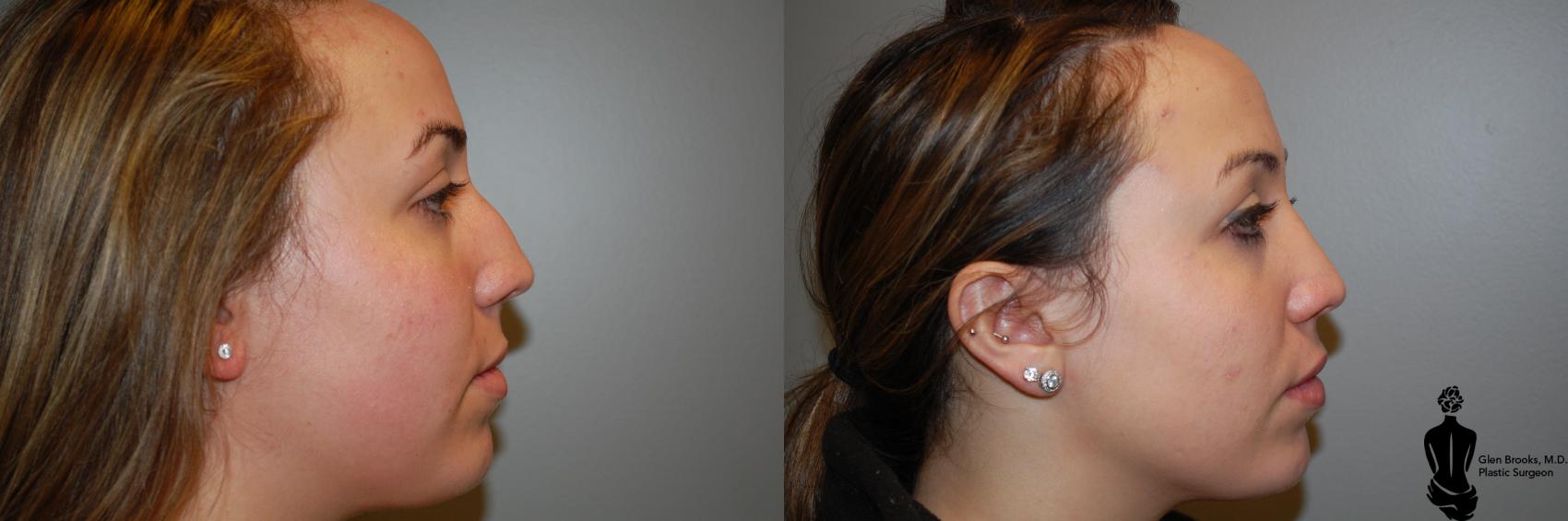 Rhinoplasty Before & After Photo | Springfield, MA | Aesthetic Plastic & Reconstructive Surgery