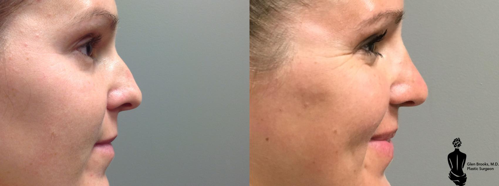 Before & After Rhinoplasty Case 99 View #1 View in Springfield, MA
